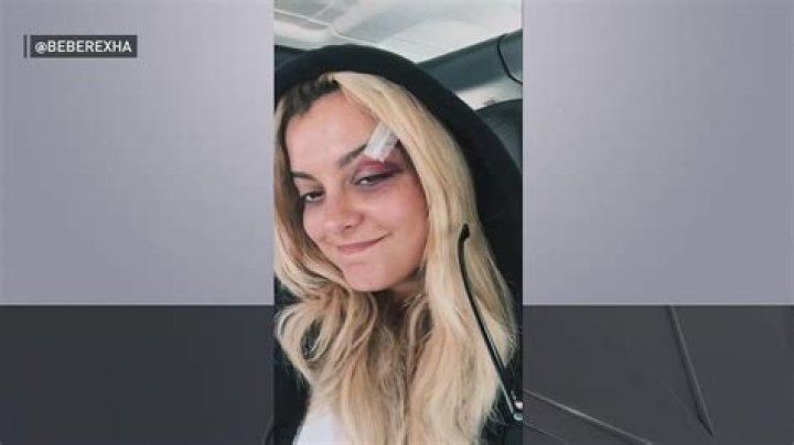 Bebe Rexha Phone Accident Led To Stitches: Cell Phone Hit Video Resurfaces