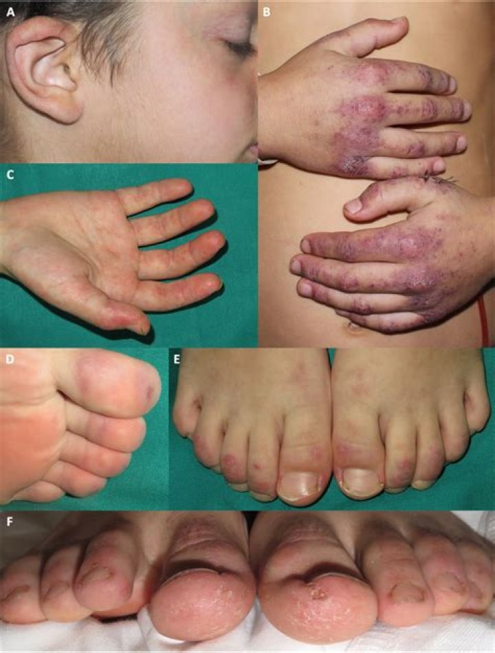 Giovanni Terzi Malattia(Illness): Diagnosed With Dermatomiosite