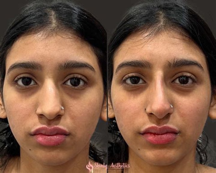 Maitreyi Ramakrishnan Nose Job Before And After Photos