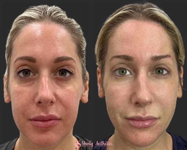 Ons Jabeur Nose Job: Before And After Photos
