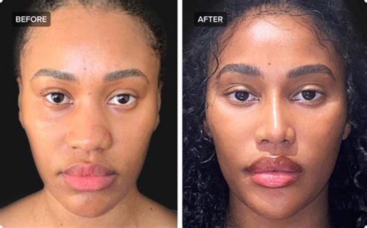 Sinead Oconnor Nose Job: Plastic Surgery Before And After Photos